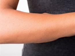 ảnh chụp màn hình bị nổi da gà liên tục là bị gì