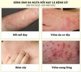 ảnh chụp màn hình da cổ bị nổi như da gà