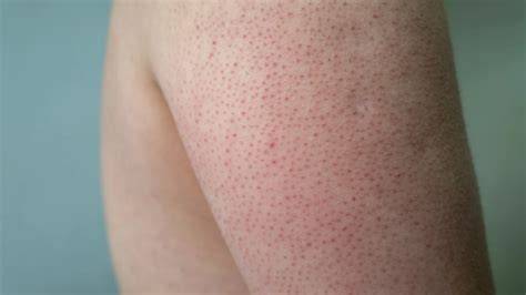 ảnh chụp màn hình da có bị sần như da gà