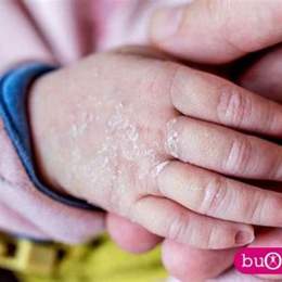 bé bị nổi hạt nhỏ như da gà