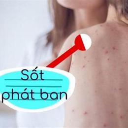 bé bị sốt nổi da gà