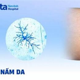 cách chữa bệnh nấm da ở gà