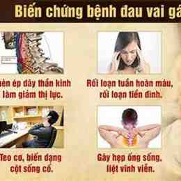 căng cơ cổ vai gáy gây đau đầu