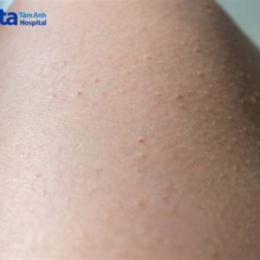 chân lông bị nổi sần từng đám như nổi da gà