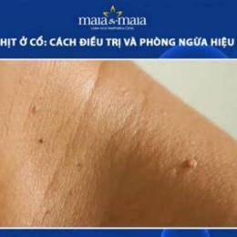cổ nổi mụn như da gà