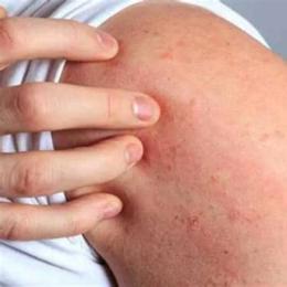 da bị nổi hột như da gà