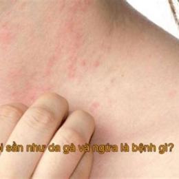 da bị sần da gà