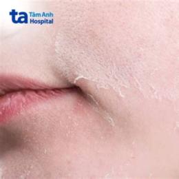 da bị sần sùi như da gà