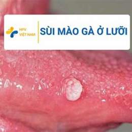 đá lưỡi có bị sùi mào gà không