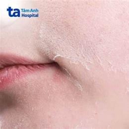 da mặt bị sần sùi như da gà