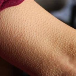da nổi sần như da gà không ngứa