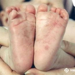 da trẻ bị sần như da gà