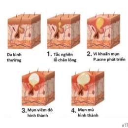 đồ ngọt gây mụn da