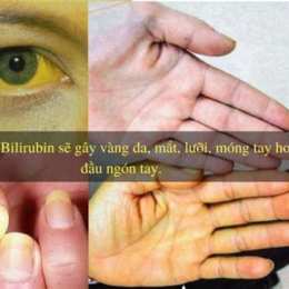 gà bị vàng da là bệnh gì