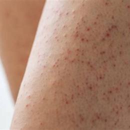 giải thích hiện tượng nổi da gà