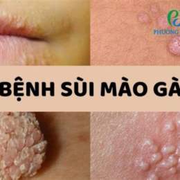 khám sùi mào gà ở bệnh viện da liễu trung ương