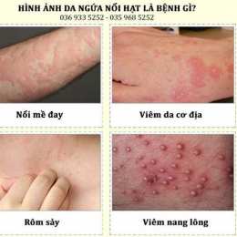 mặt láng da gà là gì