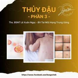 mụn nước thủy đậu gần
