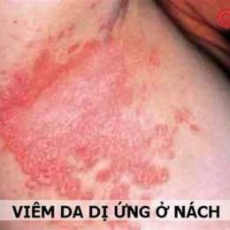 nách nổi hột như da gà
