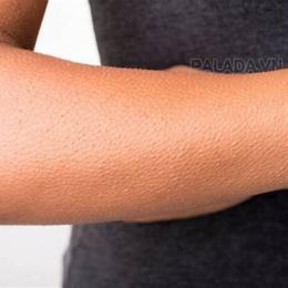 sởn da gà tiếng anh là gì