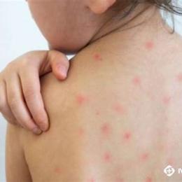 sốt nổi da gà