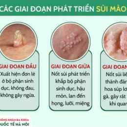 sùi mào gà da đầu