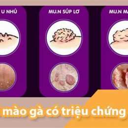 sùi mào gà dạng súp lơ