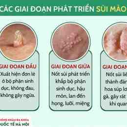 sùi mào gà ở da