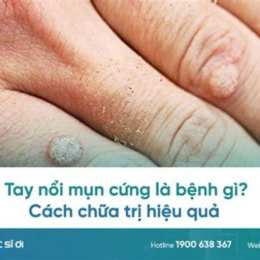 tay nổi da gà