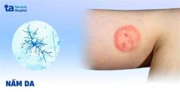 tính năng nổi bật cách phòng bệnh nấm da ở gà đẻ