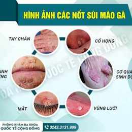tôi đã chữa khỏi sùi mào gà