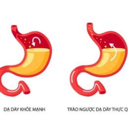 trào ngược dạ dày ăn gà được không