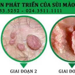 trị sùi mào gà ở bệnh viện da liễu